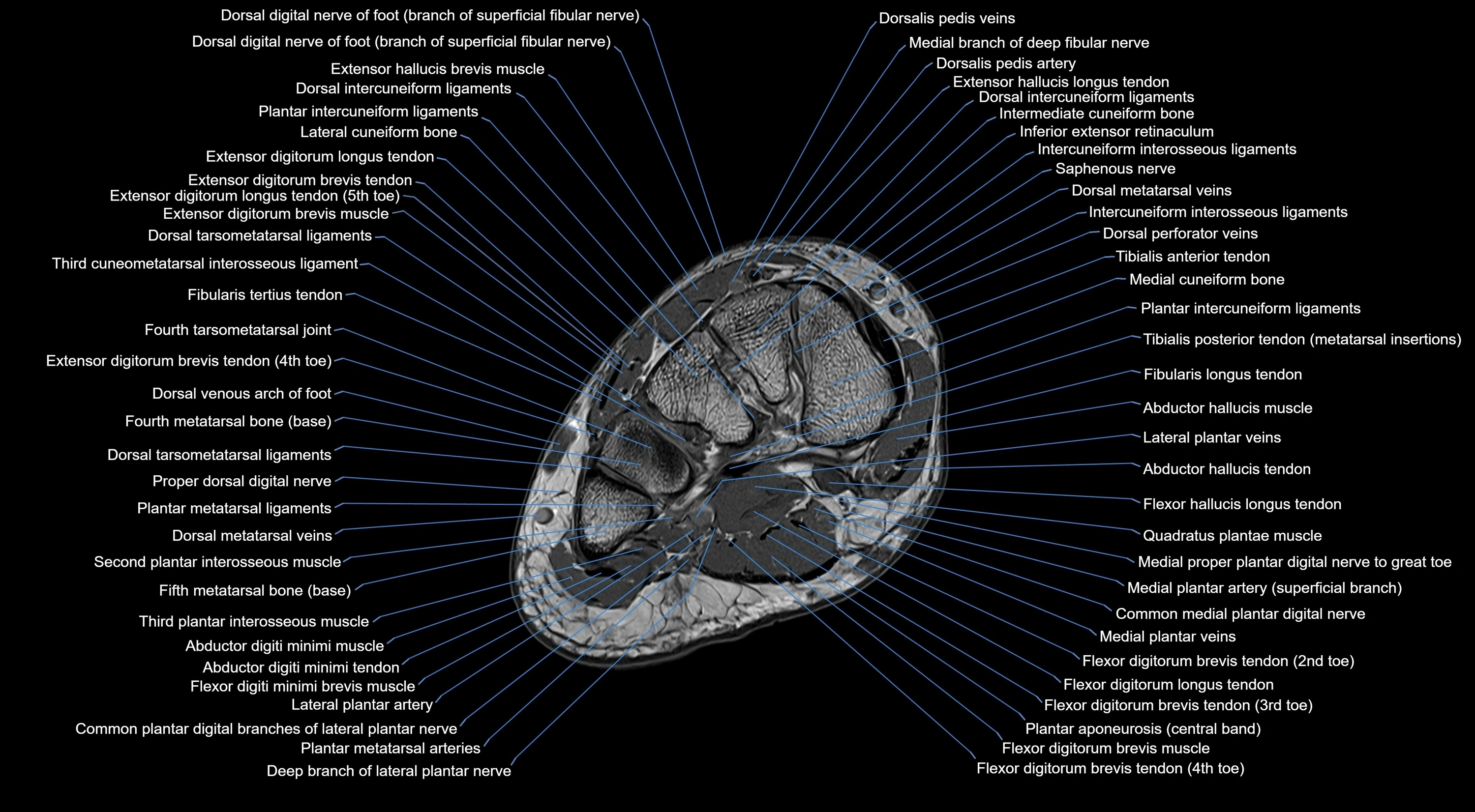 MRI mid foot coronal ligaments cross sectional anatomy 3T  radiology  image-img-00001-00020.webp